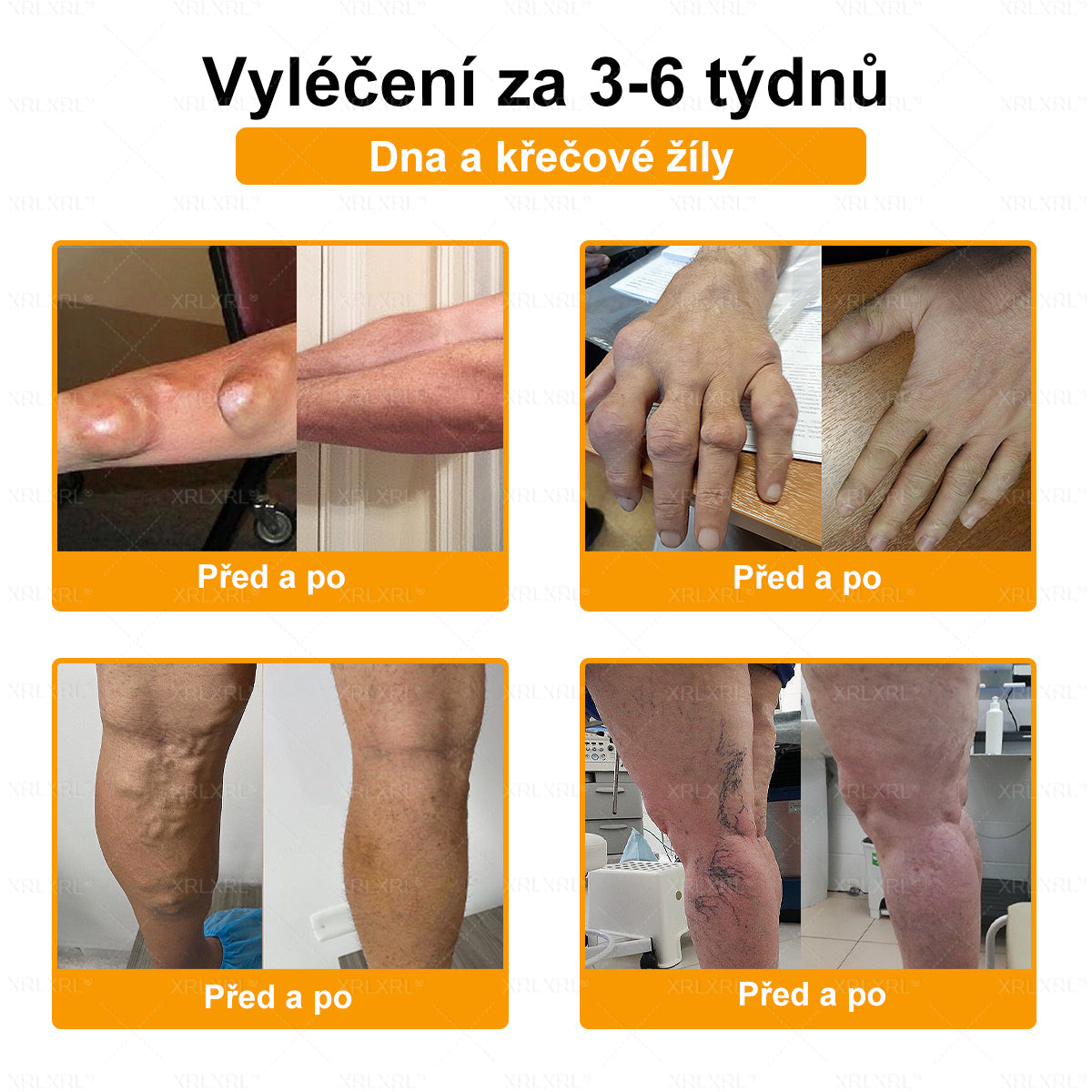 XRLXRL® Krém na úlevu od bolesti a hojení kostí s včelím jedem