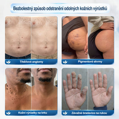 💛✅Oficiální značkový obchod | Hiskin® 7denní odstraňovač skvrn a pigmentových skvrn (Bezbolestný rollerball bez jizev)🐬