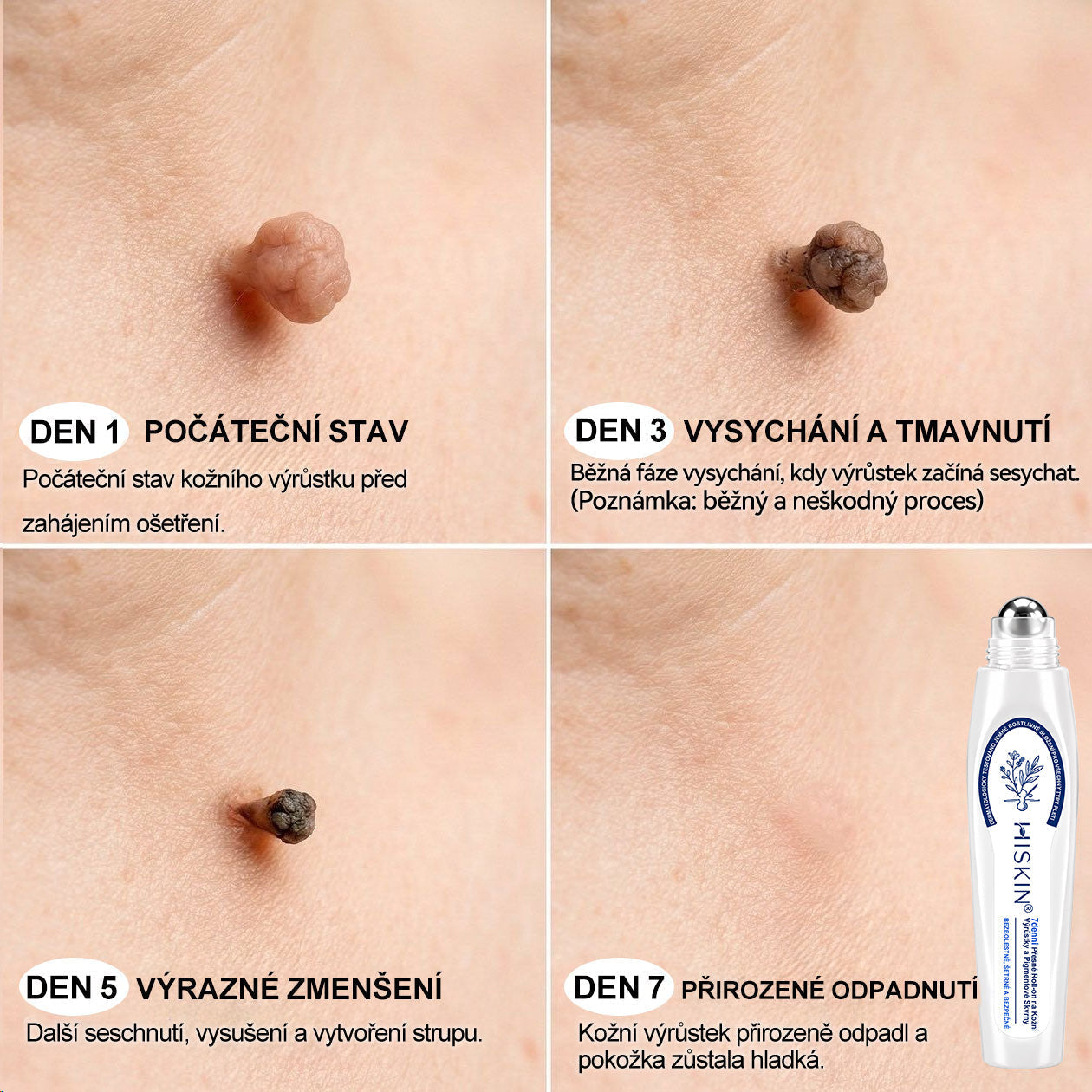 💛✅Oficiální značkový obchod | Hiskin® 7denní odstraňovač skvrn a pigmentových skvrn (Bezbolestný rollerball bez jizev)🐬