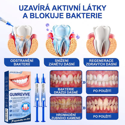 🇨🇿 🦷 𝐀𝐍𝐆𝐄𝐋𝐓𝐑𝐀𝐏®  𝐎𝐛𝐧𝐨𝐯𝐚 𝐝á𝐬𝐧í 𝐩𝐚𝐫𝐨𝐝𝐨𝐧𝐭á𝐥𝐧í 𝐨𝐩𝐫𝐚𝐯𝐧ý 𝐠𝐞